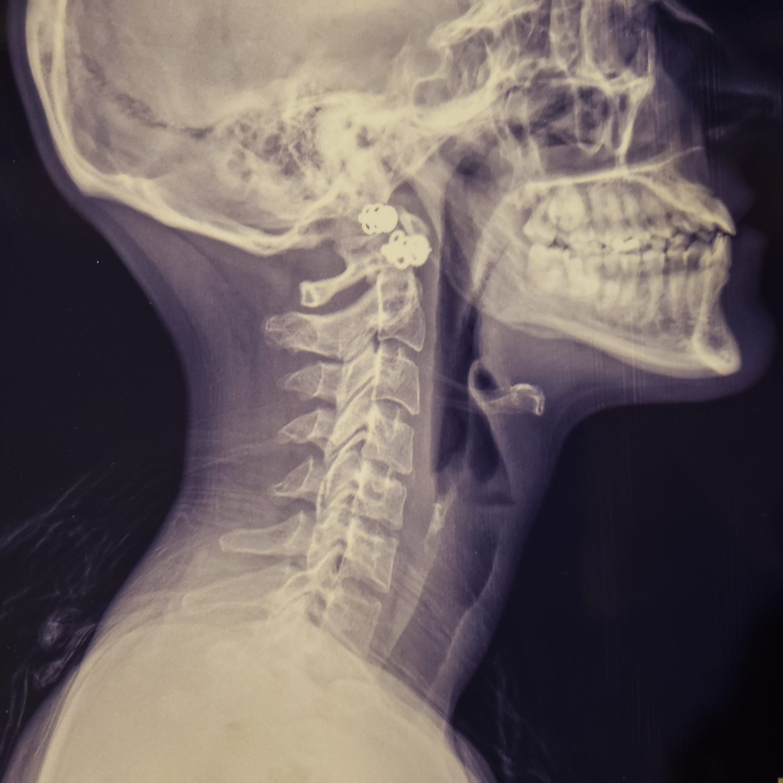 x-ray after mi-trac treatment in chiropractic practice in loganville, georgia